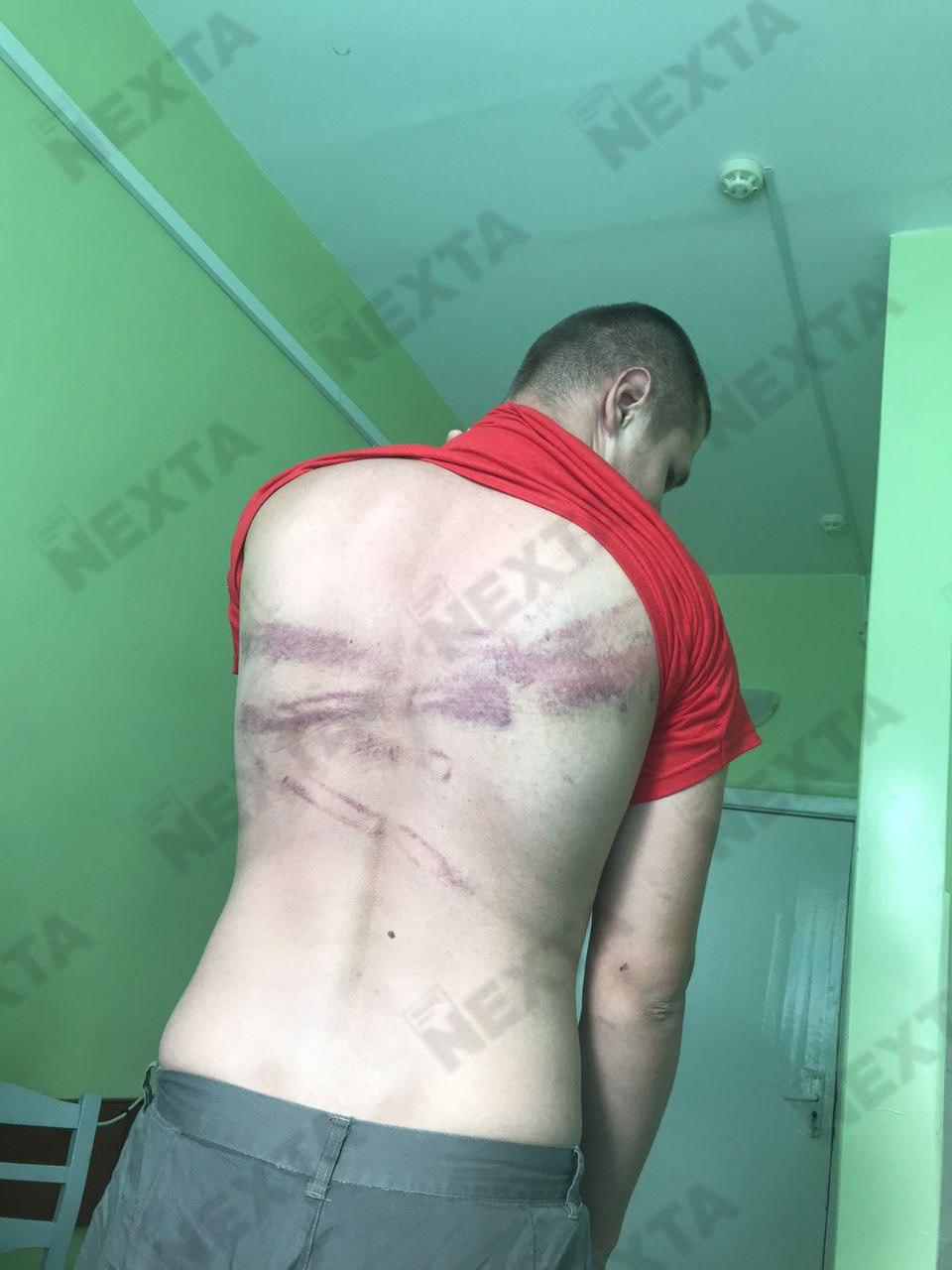 В сети показали ужасающие снимки избитых людей в Беларуси: фото 18+